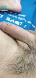 w*******y : 為什麼我弟弟有三八痣呢? 聽說性慾很強?
