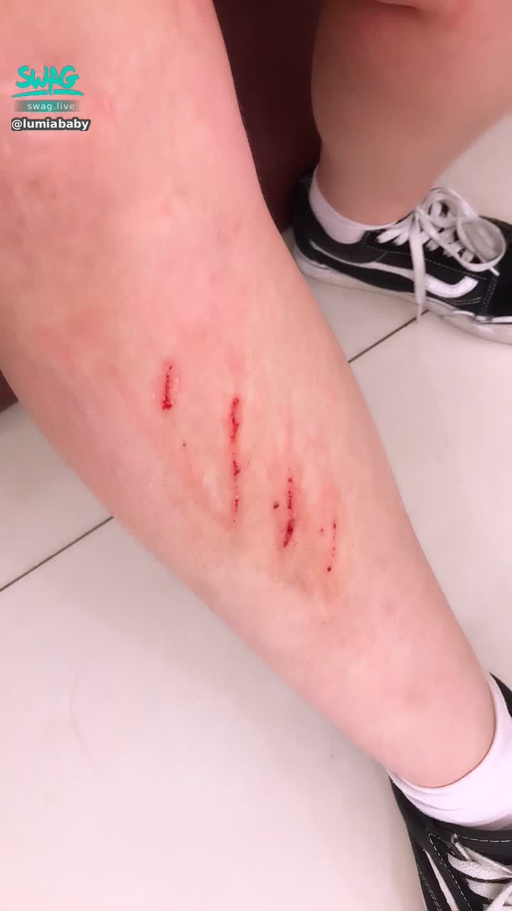 l*******y : 寶寶受傷惹🥺