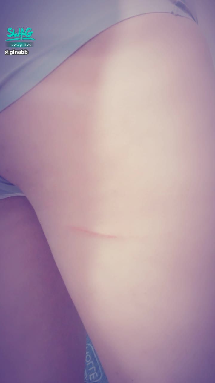  : I don't know when I got hurt! ~ scream (pain) 😱😱😱😱