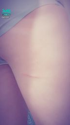 ginabb : 什麼時候受傷的我自己都不知道!~尖叫(痛)😱😱😱😱