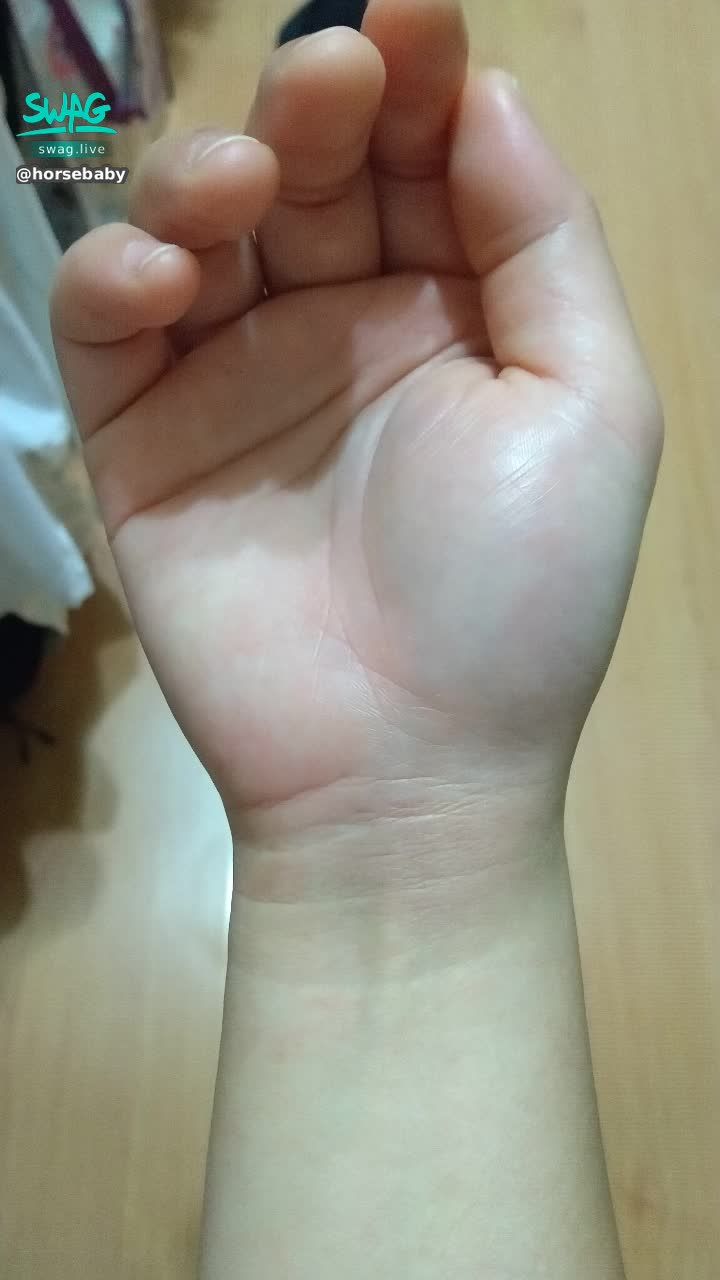  : Injury from a fall... the support of the right hand causes swelling throughout 😢
The whole hand hurts too much... I feel it will hurt even more tomorrow, so scared 😫