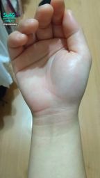 h*******y : 摔倒受傷...右手的支撐導致整個腫脹😢
整個手也太痛了...感覺明天會更痛,好害怕😫