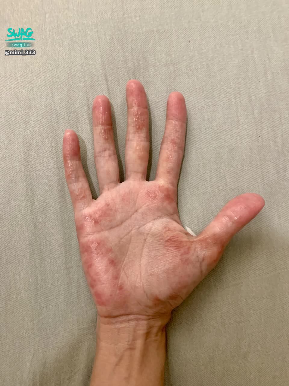 mimi_333 : 我知道照片很嚇人，但也不是24小時都這樣，就是這幾天有很多時刻是這樣

做任何事情都要戴手套，例如刷牙、洗臉，只要不碰水，狀況會稍微好一些些。

但只是也無法保證戴了手套後的悶熱流汗情況不會引起皮膚發炎
所以大概一天會反覆個幾次、但輕重不同
—————————————
總之，剛剛與Grok深入討論完，
我覺得現在皮膚症狀應不是單一狀況。一一查詢曾經使用過的處方簽藥膏的各別成分
醫生開處方簽都是單一藥膏單一療效
我今天才想到我說不定我其實也不是哪個好了，換成了哪個。而是複合狀況，才會一直反覆發作

所以！明天！
我要再去把以前使用過的藥膏購回、加上補貨現在使用的藥膏一起對抗
或許能夠再多點好轉
報告完畢！

啊！還有，
最惱人其實是小日子尚未抵達時，前